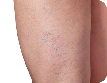 Couperose et varicosités des jambes en Nouvelle Aquitaine