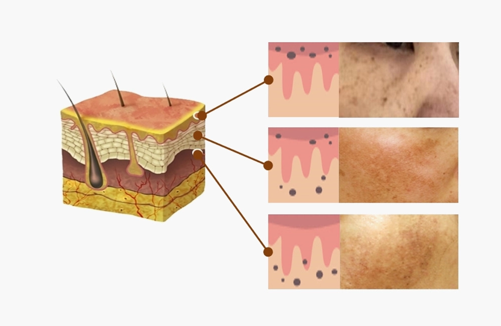 Types & Causes of Pigmentation