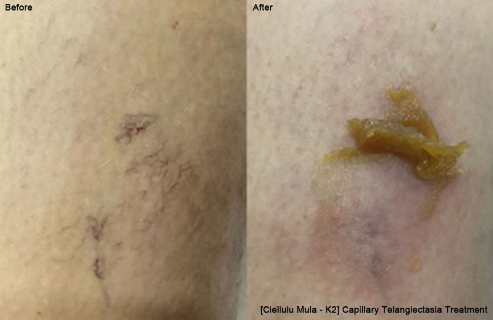 Ciellulu-Mula---K2-Capillary-Telangiectasia-Treatment-before-after