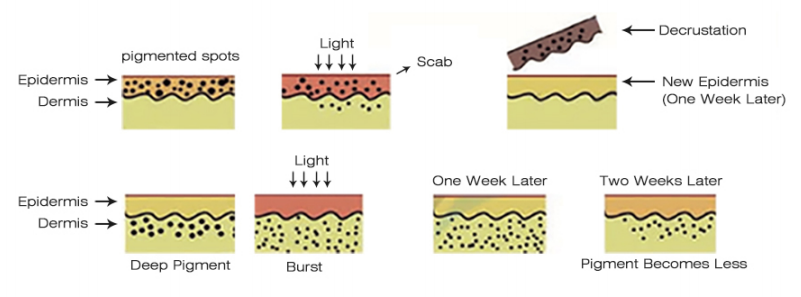 Improvement of pigmentation 2