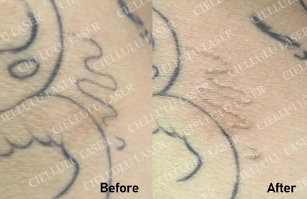 SUNFINI K6 laser tattoo removal machine Case Study