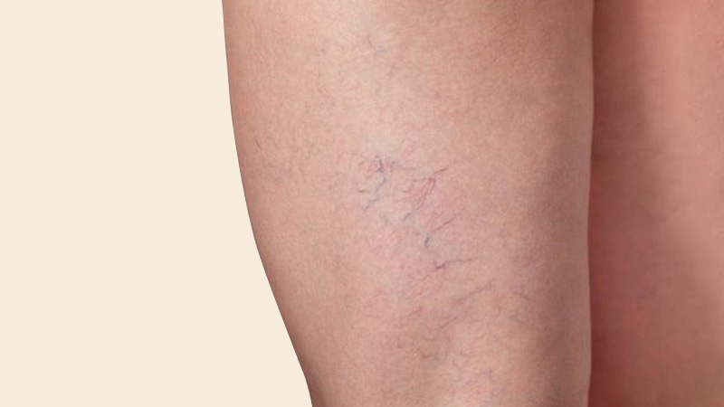 Lesiones Vasculares maquina de laser para depilar