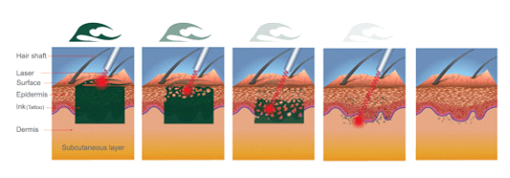 What is PICO LASER and How Does It Work