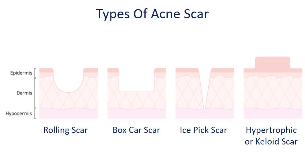 Types of Acne Scar