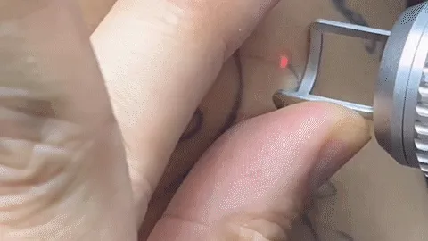 tattoo laser removal machine