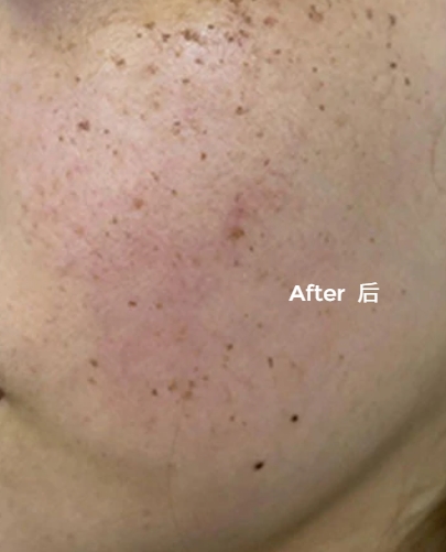 Freckle removal treatment (1h after treatment)