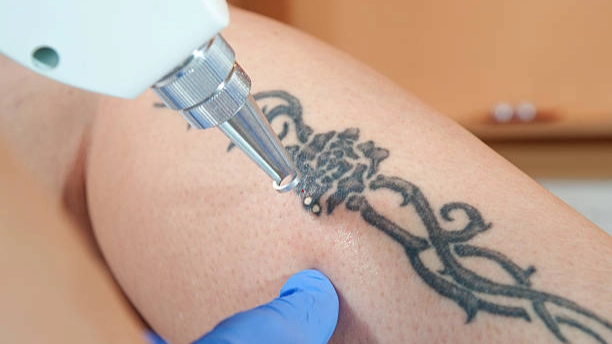A tattoo laser machine uses focused light to target and break down tattoo ink beneath the skin's surface.