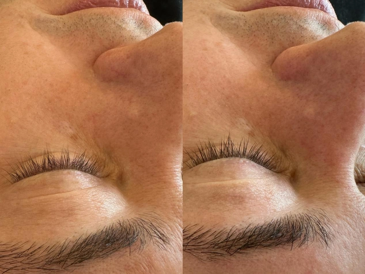 k2 ipl laser before after