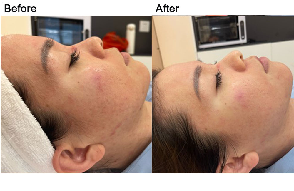 acne-removal-before-after-1