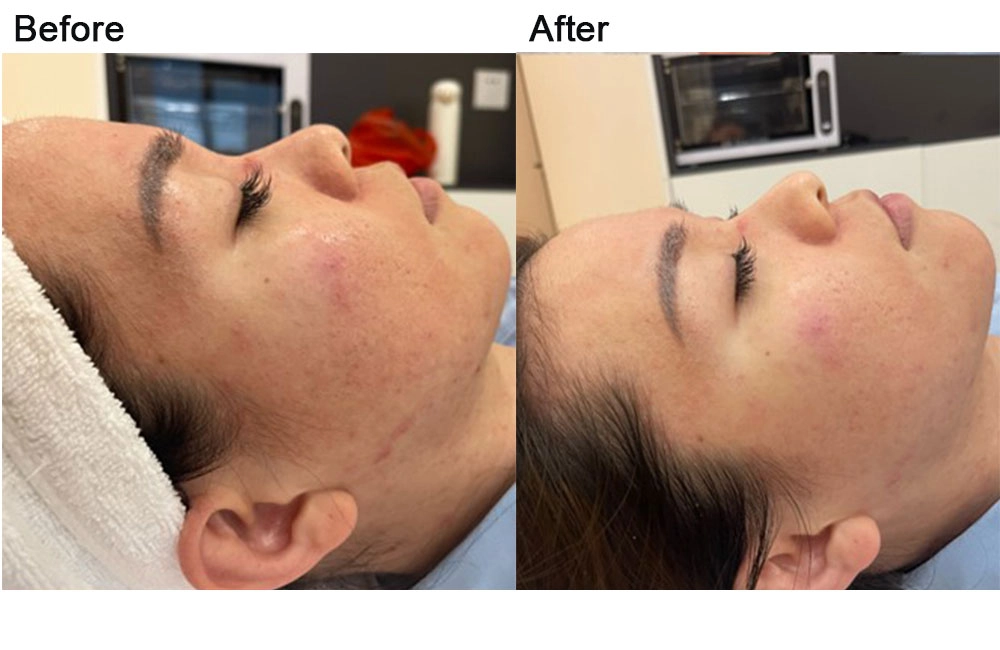 acne-removal-before-after-1