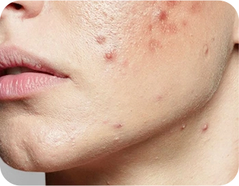 Dermatologists Share the Best Acne Advancements of the Last 5 Years