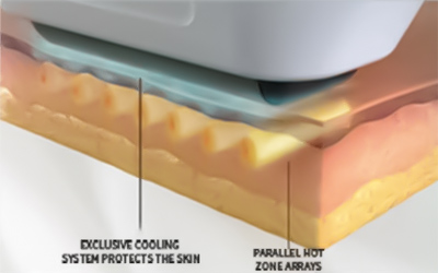 ADVANTAGE best professional laser hair removal machine