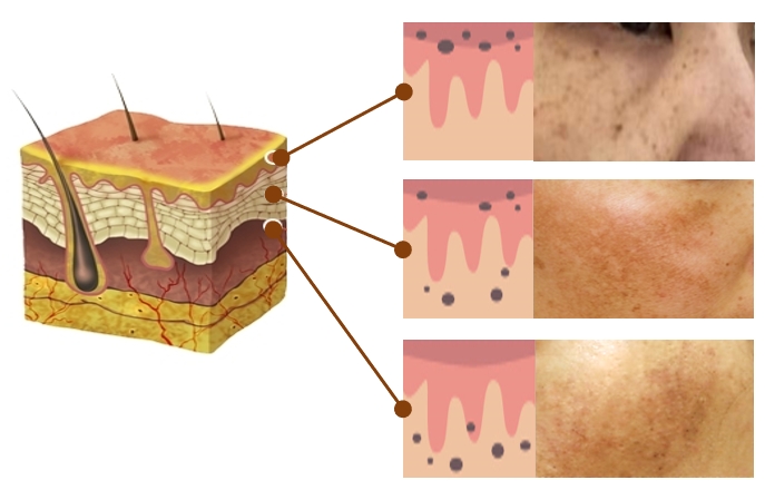 Pigmentation