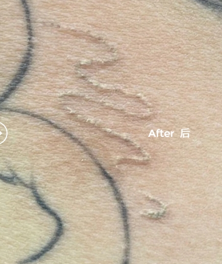 CIELLULU Tattoo removal treatment