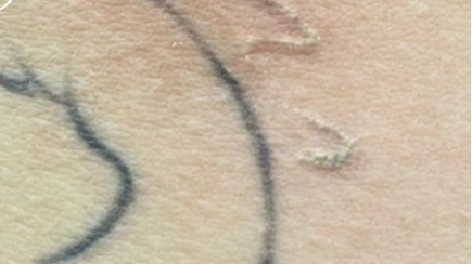CIELLULU Tattoo removal treatment