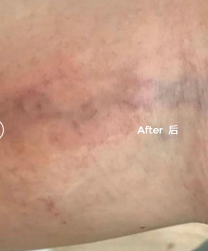 CIELLULU Vascular treatment