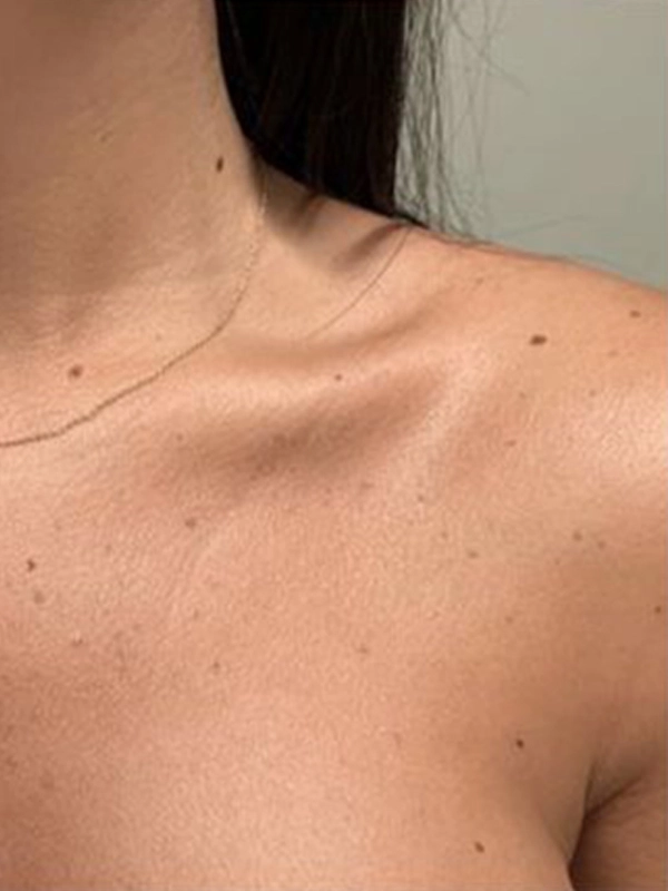 Eliminación de pecas en el pecho Eliminación de pecas en el pecho