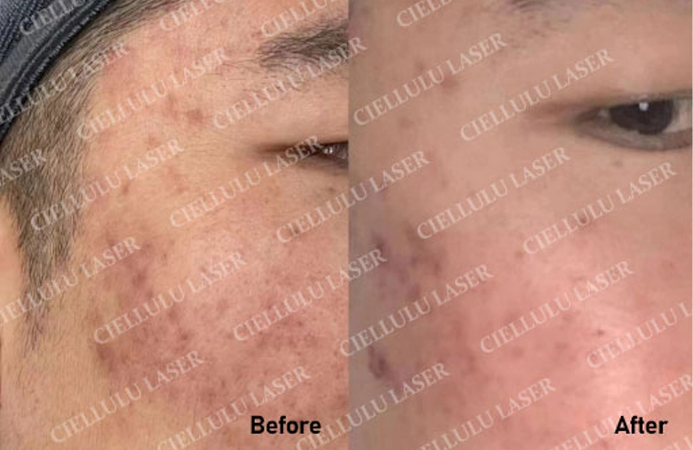 IPL K2 Acne Treatment for Mr. Li Using IPL Laser Technology