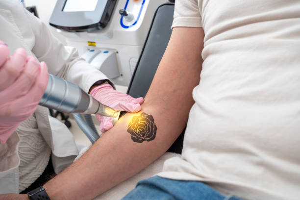 A tattoo removal device uses advanced laser technology to break down tattoo ink, helping to fade and eliminate unwanted tattoos effectively. 