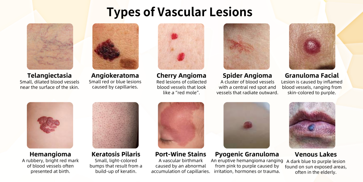 Types of Vascular lesions