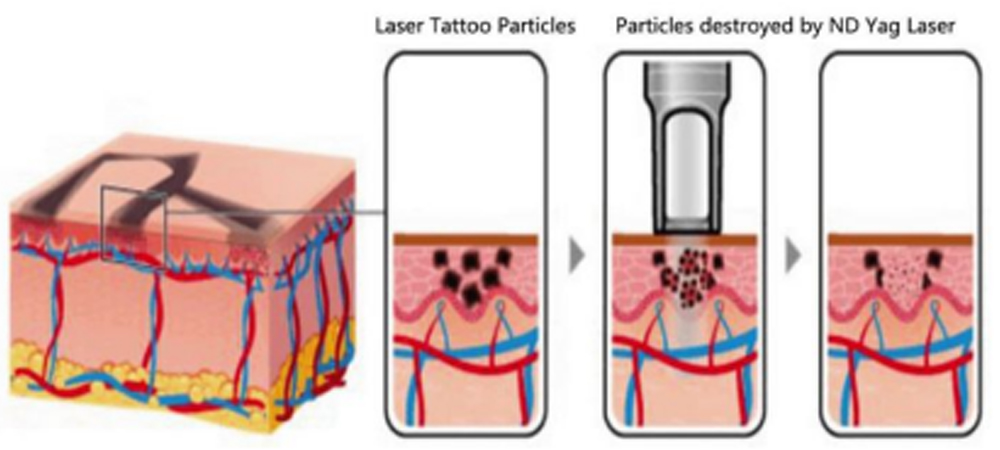 Background on q switched nd yag laser