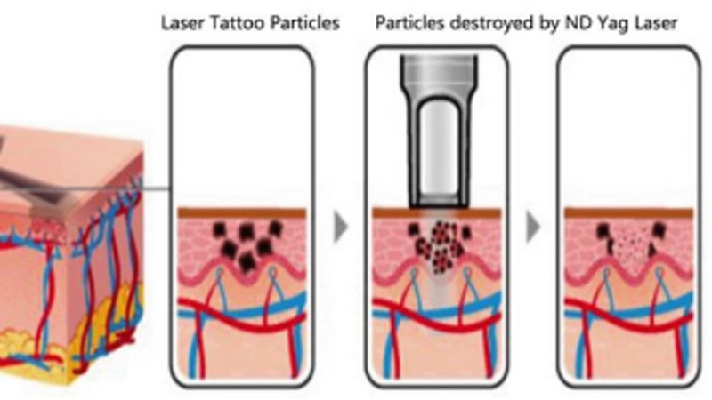 Background on q switched nd yag laser