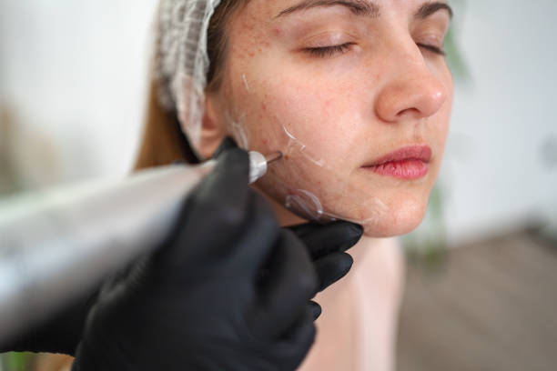 IPL acne treatment uses broad-spectrum light to penetrate the skin, reducing inflammation, killing bacteria, and effectively treating acne and pimples.