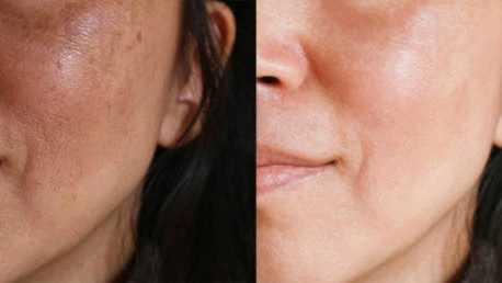 Here's an alt text option for the image:

IPL for pigmentation: Before & after skin treatment.