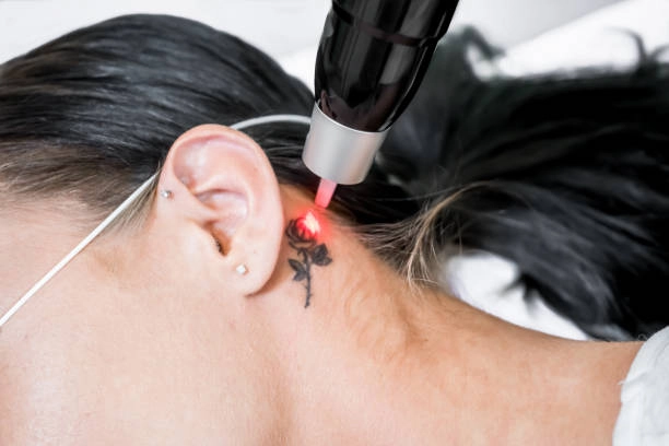 Restore natural look using professional tattoo removal laser machine