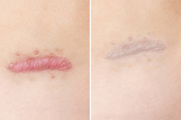 Before & after: Lasers for acne scars treatment showing significant improvement in scar appearance.