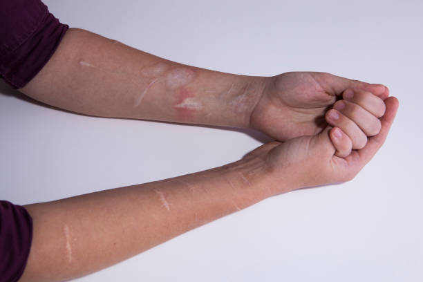 Person's arms showing self-harm scars.