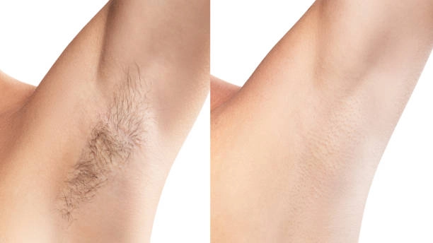 Before & after underarm hair removal with medical grade laser hair removal machine.