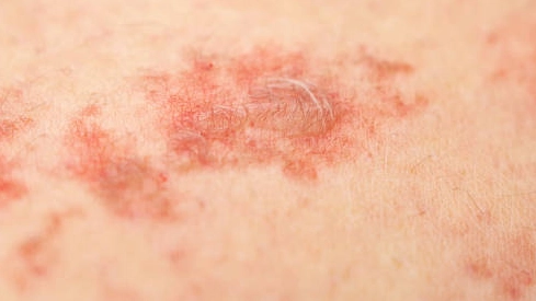 Close-up of self-harm scars on skin.