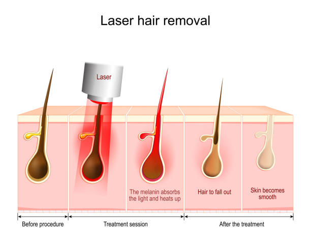 Here's an alt text option:

`Épilation laser ratée: Schéma laser`