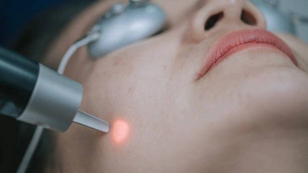 Le traitement actif contre l'acné au laser, alimenté par un équipement de beauté laser innovant, agit pour éliminer l'acné kystique tenace et prévenir les futures poussées. Le traitement actif de l’acné au laser, alimenté par un équipement de beauté laser innovant, agit pour éliminer l’acné kystique tenace et prévenir les futures éruptions cutanées.