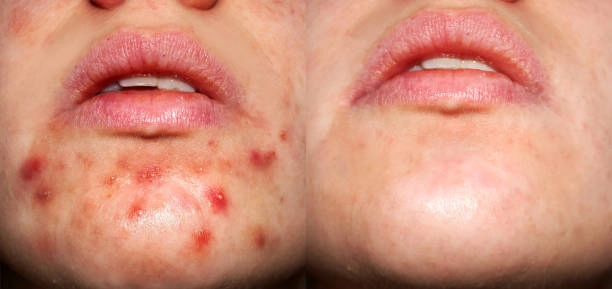 Laser Aesthetica offers advanced acne treatment solutions that target and reduce breakouts with precision.