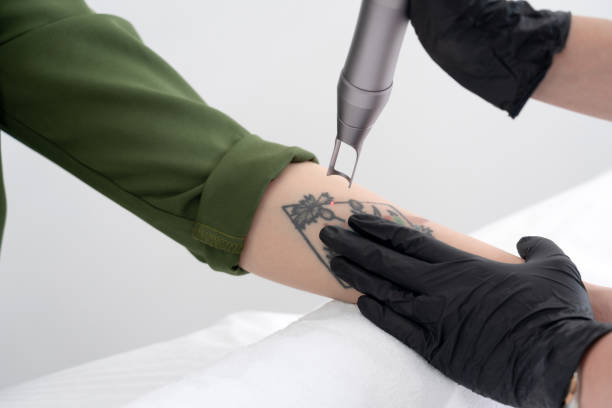 picosecond laser tattoo removal