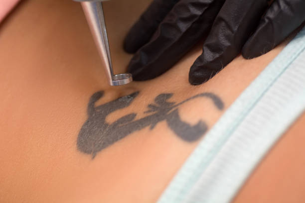 Q-switched laser tattoo removal employs rapid laser pulses to shatter tattoo ink particles, enabling faster, more efficient removal with minimal discomfort.