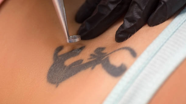 Q-switched laser tattoo removal employs rapid laser pulses to shatter tattoo ink particles, enabling faster, more efficient removal with minimal discomfort.
