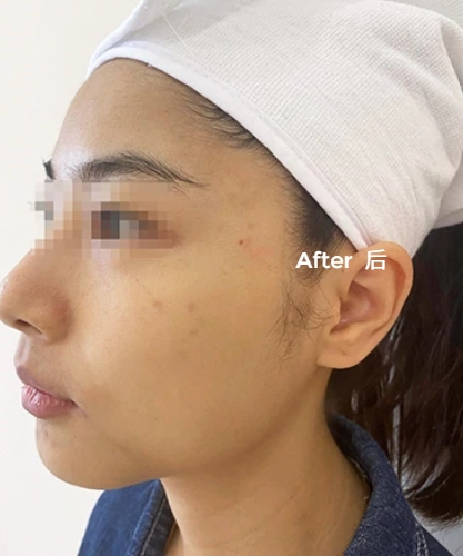 skinrejuvenation treatment