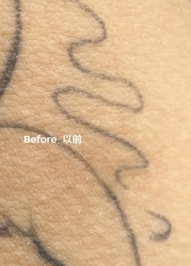 Tattoo removal treatment