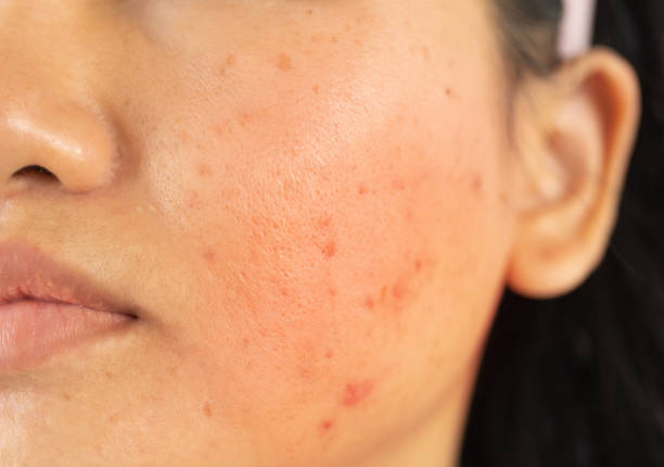 O melhor tratamento facial para acne combina vários métodos, incluindo limpeza profunda, tratamentos anti-inflamatórios e cuidados profissionais, para melhorar a pele propensa à acne.