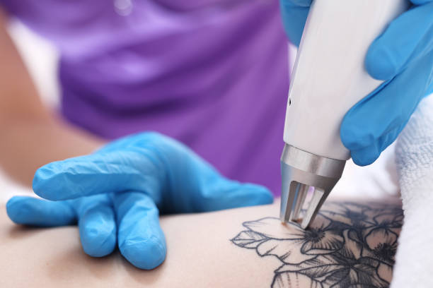 La mejor máquina de eliminación de tatuajes con láser ofrece tratamientos precisos y no invasivos para eliminar tatuajes de forma segura con una molestia mínima y una recuperación más rápida.