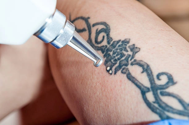 La máquina de eliminación de tatuajes con láser ND-YAG utiliza tecnología avanzada para descomponer las partículas de tinta, lo que garantiza una eliminación de tatuajes eficaz y segura. La máquina de eliminación de tatuajes con láser ND YAG utiliza tecnología avanzada para descomponer las partículas de tinta, lo que garantiza una eliminación de tatuajes eficaz y segura.