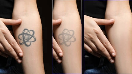 The picosecond laser tattoo removal machine delivers ultra-short pulses of energy, providing faster and more precise tattoo removal with minimal skin damage.