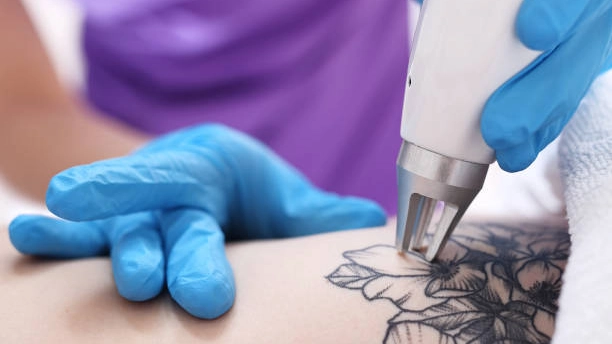 The picosecond laser tattoo removal machine offers advanced technology for faster and more accurate tattoo removal.