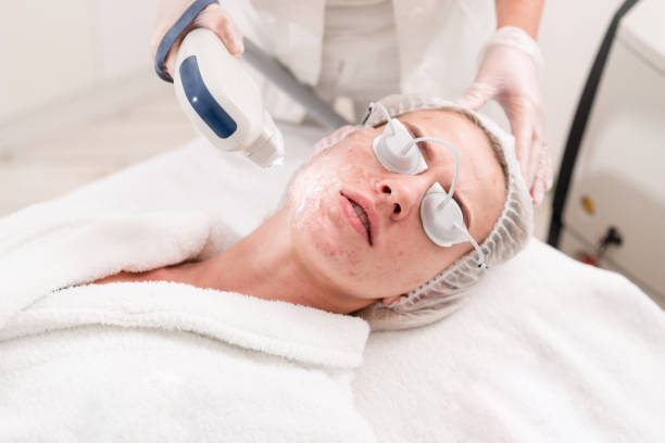 Using laser beauty equipment like the Q-switch ND YAG laser can treat active acne by focusing on deep skin layers to reduce inflammation and clear breakouts