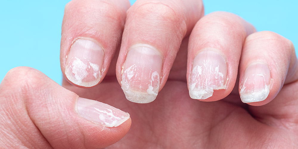 Poor nail condition